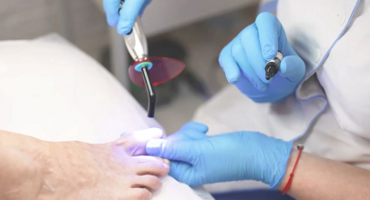 Чи можна вилікувати грибок нігтя лазером?